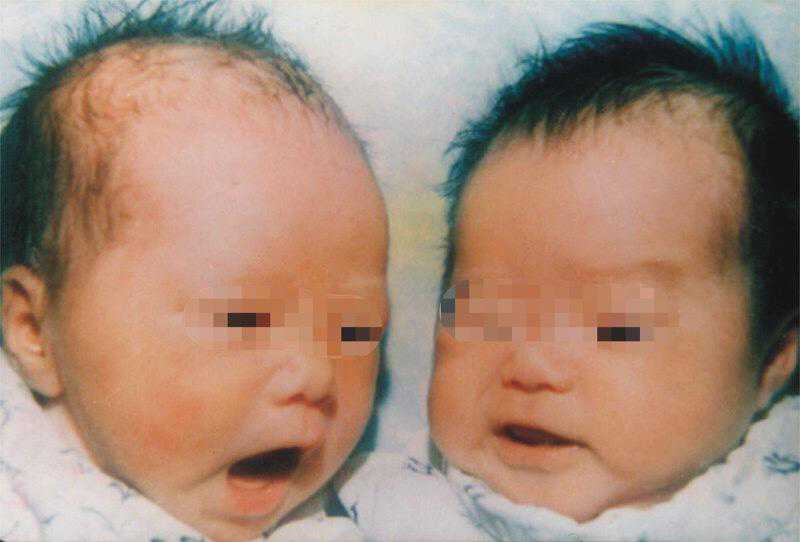 大陆首例试管婴儿当妈妈了！广东首例试管婴儿现在如何？