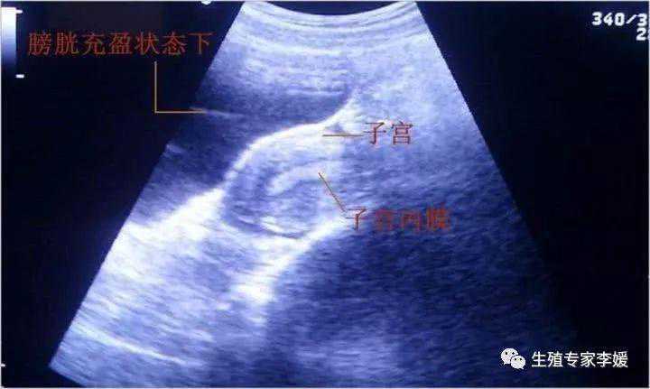 做试管婴儿胚胎移植前后有哪些误区？