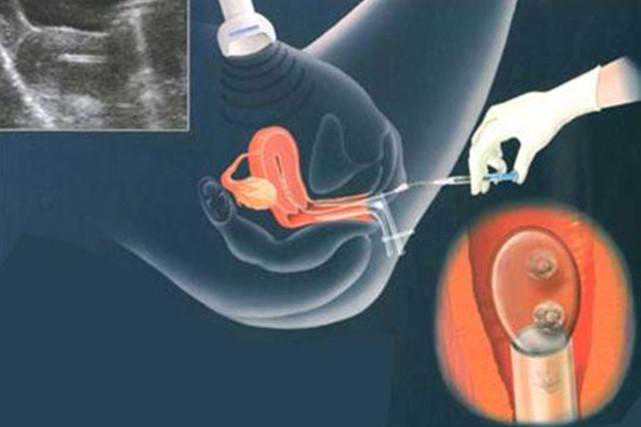 试管等于200多针、几次手术和精神煎熬 看了下辈子还想做女人吗？