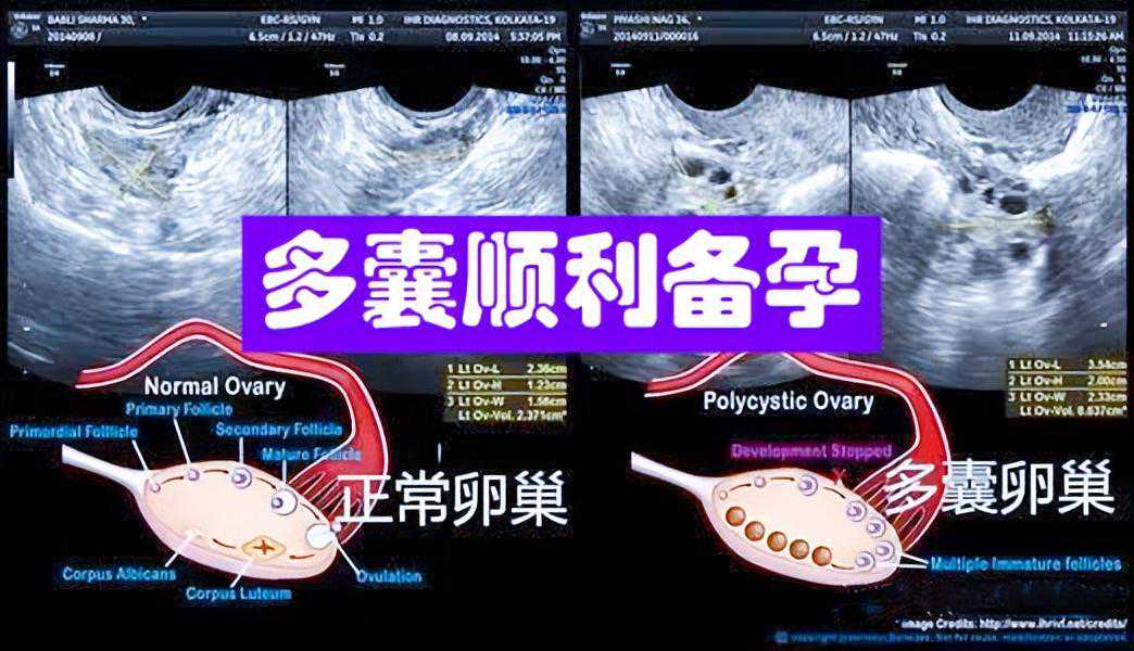 多囊备孕难，1杯茶1个穴位，告别激素药，多囊消失好孕自来
